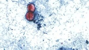 Cyclosporiasis Outbreak 2026: Symptoms, Sources, Treatment and Prevention 20260713_182022